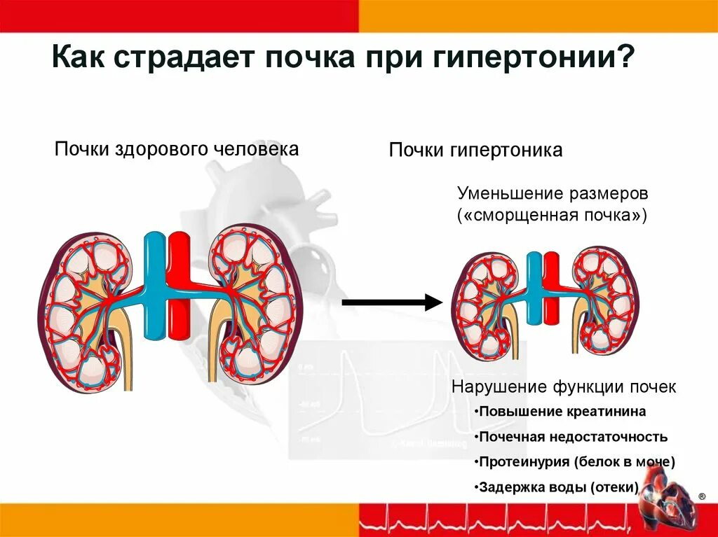 Давление при заболевании почек. Гипертоническая болезнь с поражением почек. Почечная форма гипертонической болезни. Поражение почек при артериальной гипертензии. Почки при гипертонической болезни.