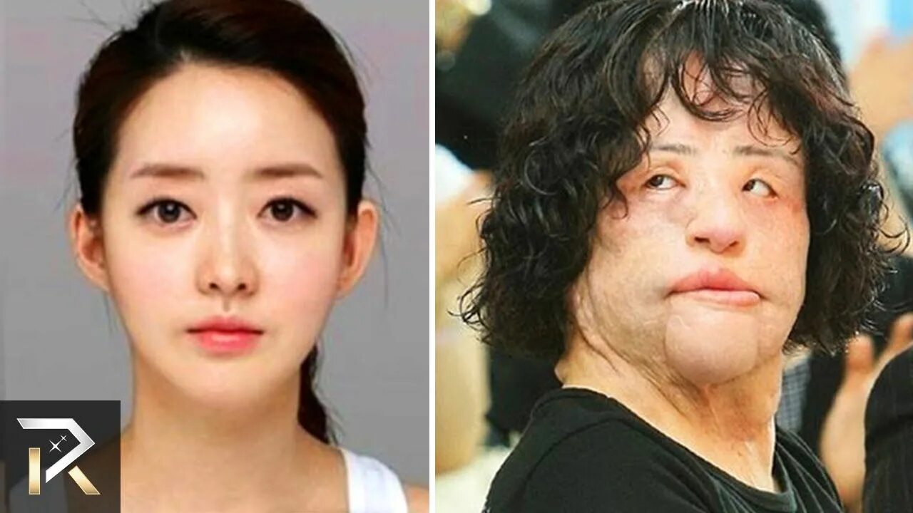 Аугментационная ринопластика. Пластическая операция на подбородок. Люди до и после пластики лица. Тюкин валентин юрьевич ринопластика. Ментопластика (гениопластика).