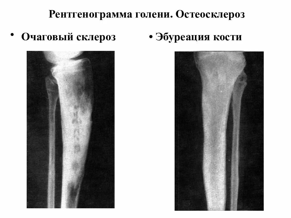 Структурные изменения костей. Очаговый остеосклероз большеберцовой кости. Остеосклероз кости рентген. Локальный остеосклероз бедренной кости. Остеосклеротический очаг бедренной кости.