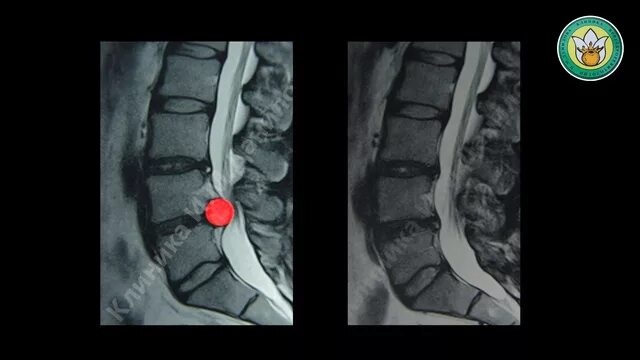 Вырезание грыжи позвоночника. Стертые диски позвоночника. Стирание позвоночных дисков. Стерлись позвоночные диски. Операция на дисках позвоночника