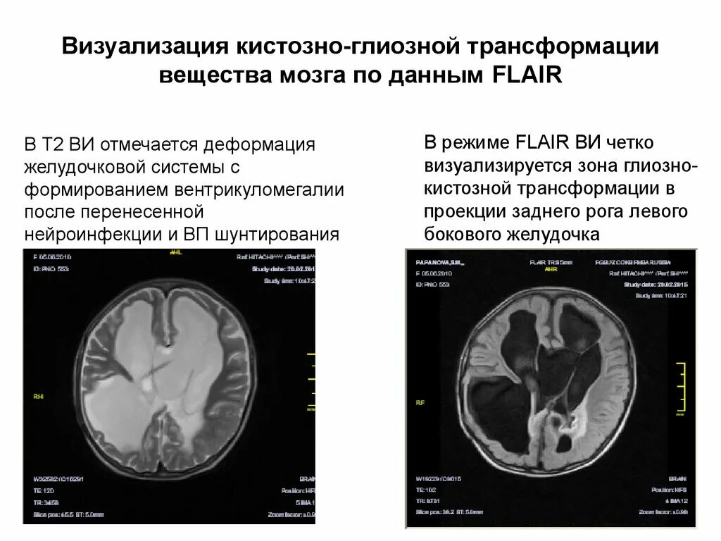 Глиозные изменения лобной доли