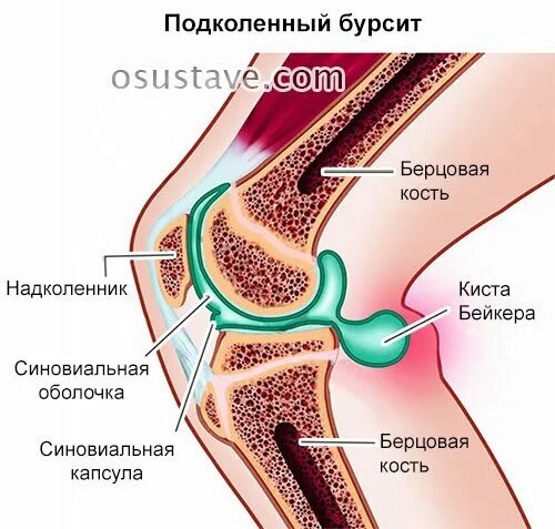 болит сбоку колена лечение. болит сбоку колена лечение. болит колено с внутренней стороны. болит сбоку коленного сустава. болит сбоку колена лечение.