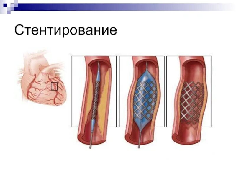 Стентирование собаки. Коллапс трахеи стентирование. Стентирование трахеи у собак. Стентирование просвета трахеи. Трахеобронхиальное стентирование.