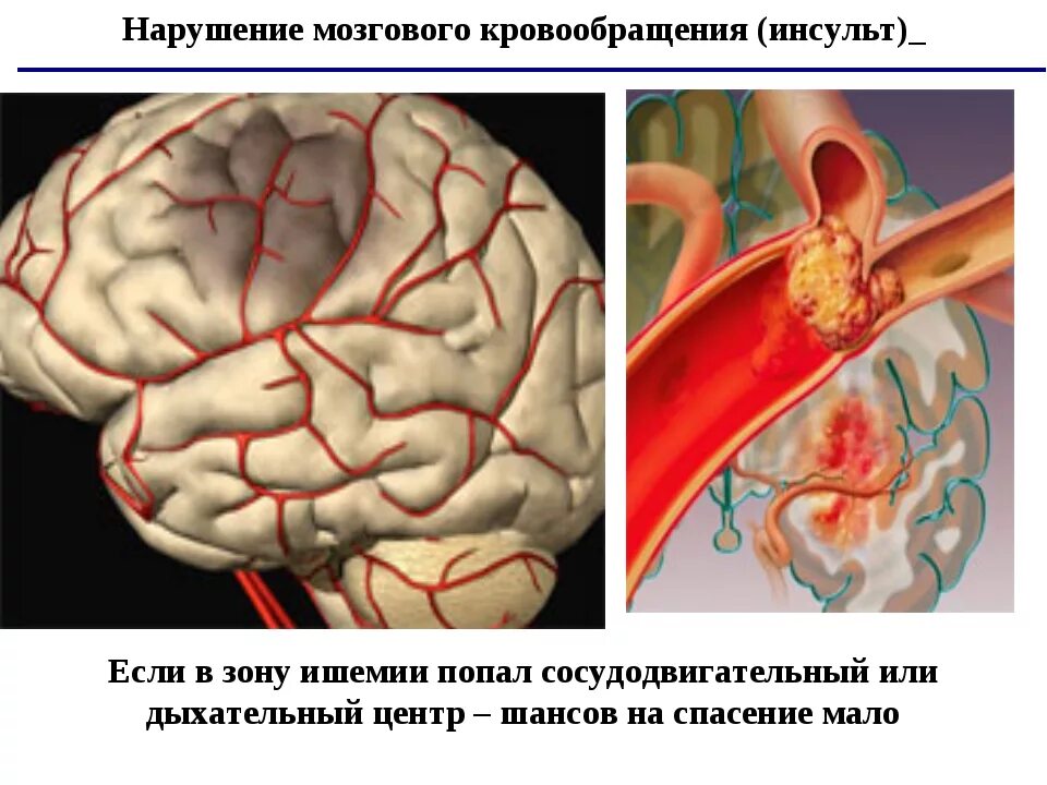 Зона ишемии. Нарушение мозгового кровообращения. Нарушение кровообращения головного мозга. Нарушение мозгового кровообращения инсульт. Нарушение кровоснабжения головного мозга.