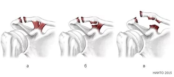 Разрыв сочленений. Разрыв акромиально-ключичного сустава операция. Растяжение акс плечевого сустава. Ключица разрыв связок пластина. Разрыв связок плечевого сустава акс.