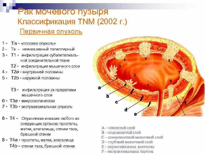 2 стадия рака мочевого пузыря