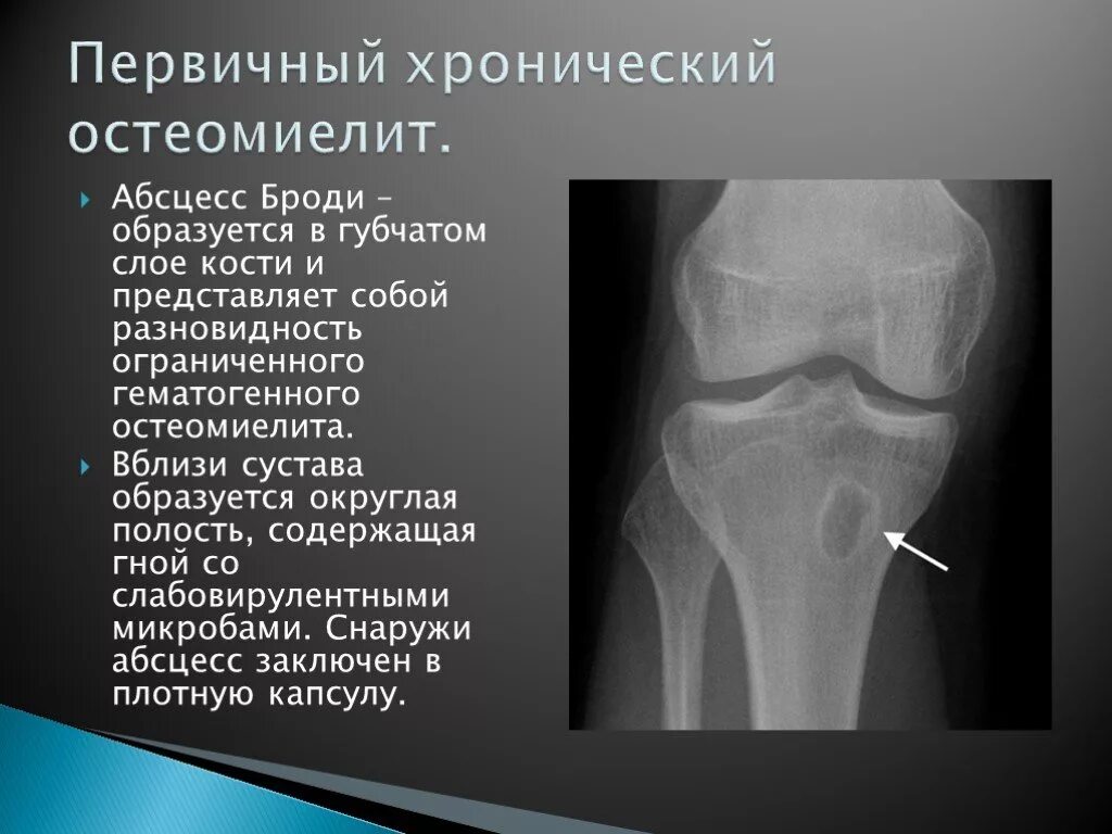 Гематогенный остеомиелит плечевой кости рентген. Хронический остеомиелит большеберцовой кости кт. Первично хронический остеомиелит рентген. Остеомиелит Броди абсцесс. Гнойные заболевания суставов