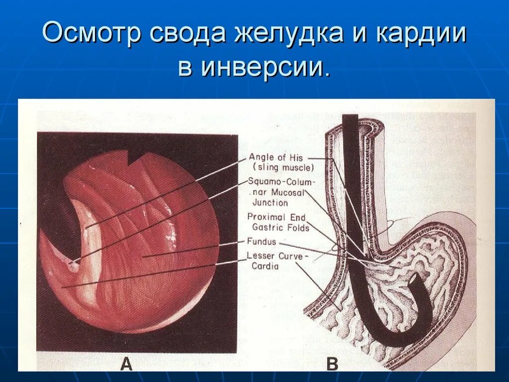 Пищевод желудок Кардия. Кардия желудка что это такое анатомия. Строение кардии желудка. Пищевод и желудок анатомия. Своды образования 38