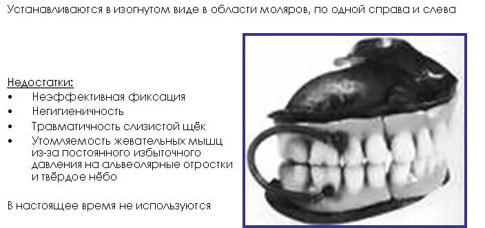 Фиксация и стабилизация полных съемных протезов. Методам фиксации полных съёмных протезов. механический метод фиксации полных съемных протезов. способы фиксации полных съемных протезов. механические методы фиксации полных съемных пластиночных протезов..