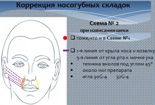 ДМАЕ схема введения. Схема мезотерапии лица с ДМАЕ. Схема уколов ДМАЕ. ДМАЕ схема введения лицо.