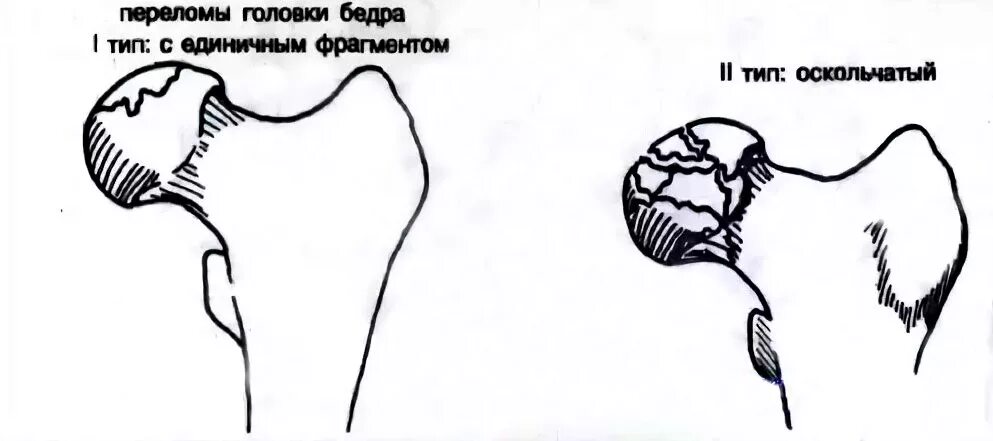 Перелом головки бедренной кости классификация. Повреждение головки бедренной кости. Повреждение головки бедренной кости. Импрессионный перелом головки бедренной кости. Вколоченный перелом шейки бедра рентген.