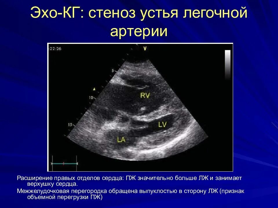Дилатация правых отделов. Стеноз легочного клапана ЭХОКГ. Аортальная недостаточность эхокардиография. Подклапанный стеноз легочной артерии на ЭХОКГ. Стеноз легочной артерии у детей ЭХОКГ.