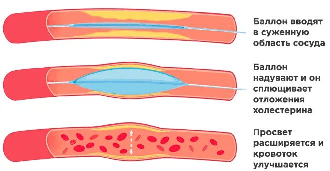 Баллонная ангиопластика нижних конечностей. Баллонная ангиопластика артерий нижних конечностей. Баллонная ангиопластика коронарных артерий техника. Баллонная вазодилатация (ангиопластика периферических артерий). ТРАНСЛЮМИНАЛЬНАЯ баллонная ангиопластика нижних конечностей.