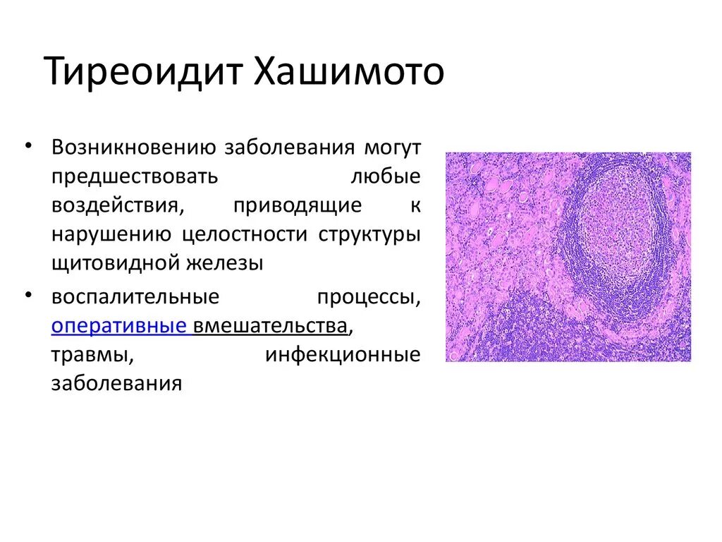 Аутоиммунный тиреоидит Хашимото микропрепарат патанатомия. Аутоиммунный тиреоидит зоб Хашимото микропрепарат. Макропрепарат тиреоидит Хашимото. Аутоиммунный тиреоидит Хашимото микропрепарат описание. Лимфоцитарный тиреоидит