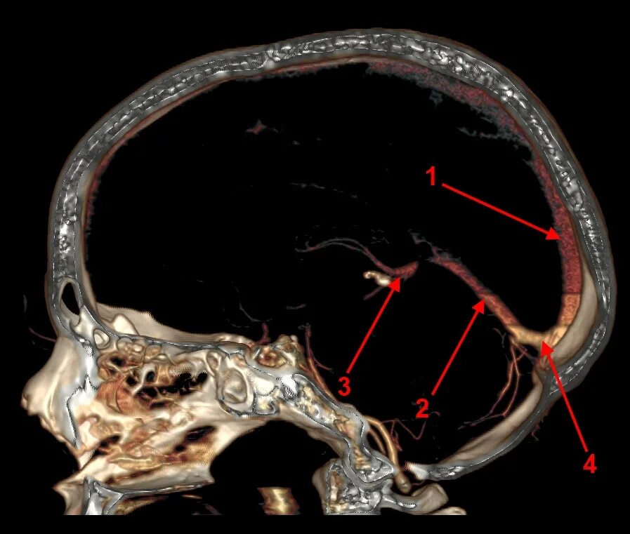 Тромбоз сигмовидного синуса на кт. Верхний Сагиттальный синус головного мозга кт анатомия. Тромбоз поперечного синуса кт. Гипоплазия правого поперечного синуса