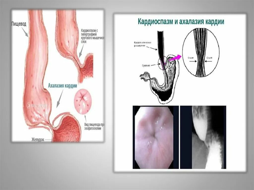 Ахалазия пищевода ФГДС. Рентген при ахалазии кардии. Клинический симптом ахалазии кардии. Ахалазия пищевода 1 степени. Халазия пищевода