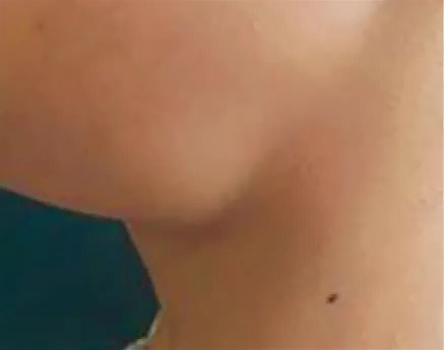 дополнительная молочная долька под мышкой