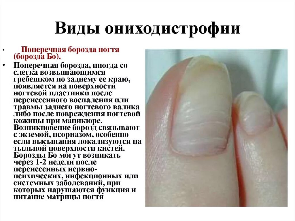 Что означают полосы на ногтях. Продольные и поперечные борозды на ногтях. Поперечные борозды на ногтях.