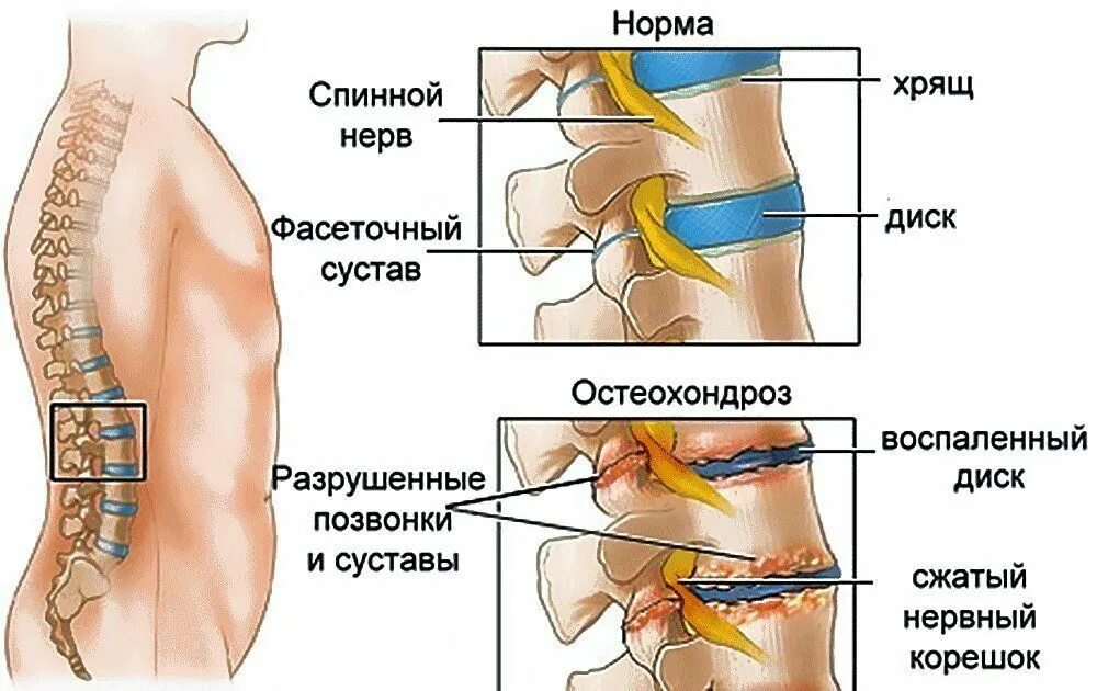 Давление в пояснице. Блокада фасеточного сустава l5-s1. Остеохондроз поясничного отдела позвоночника. Пояснично-крестцовый отдел позвоночника l3. Остеохондроз пояснично-крестцового отдела позвоночника.