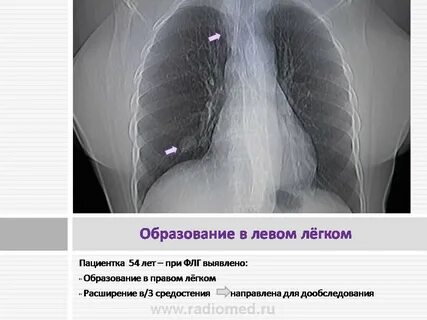 Аберрантная правая подключичная артерия у плода
