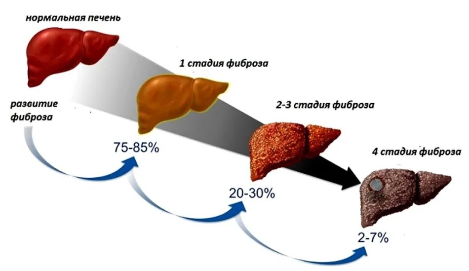 Отказала печень сколько. Стадии хронического гепатита. Цирроз печени стадии развития. Фиброз гепатоз печени цирроз. Стадии развития фиброза печени.