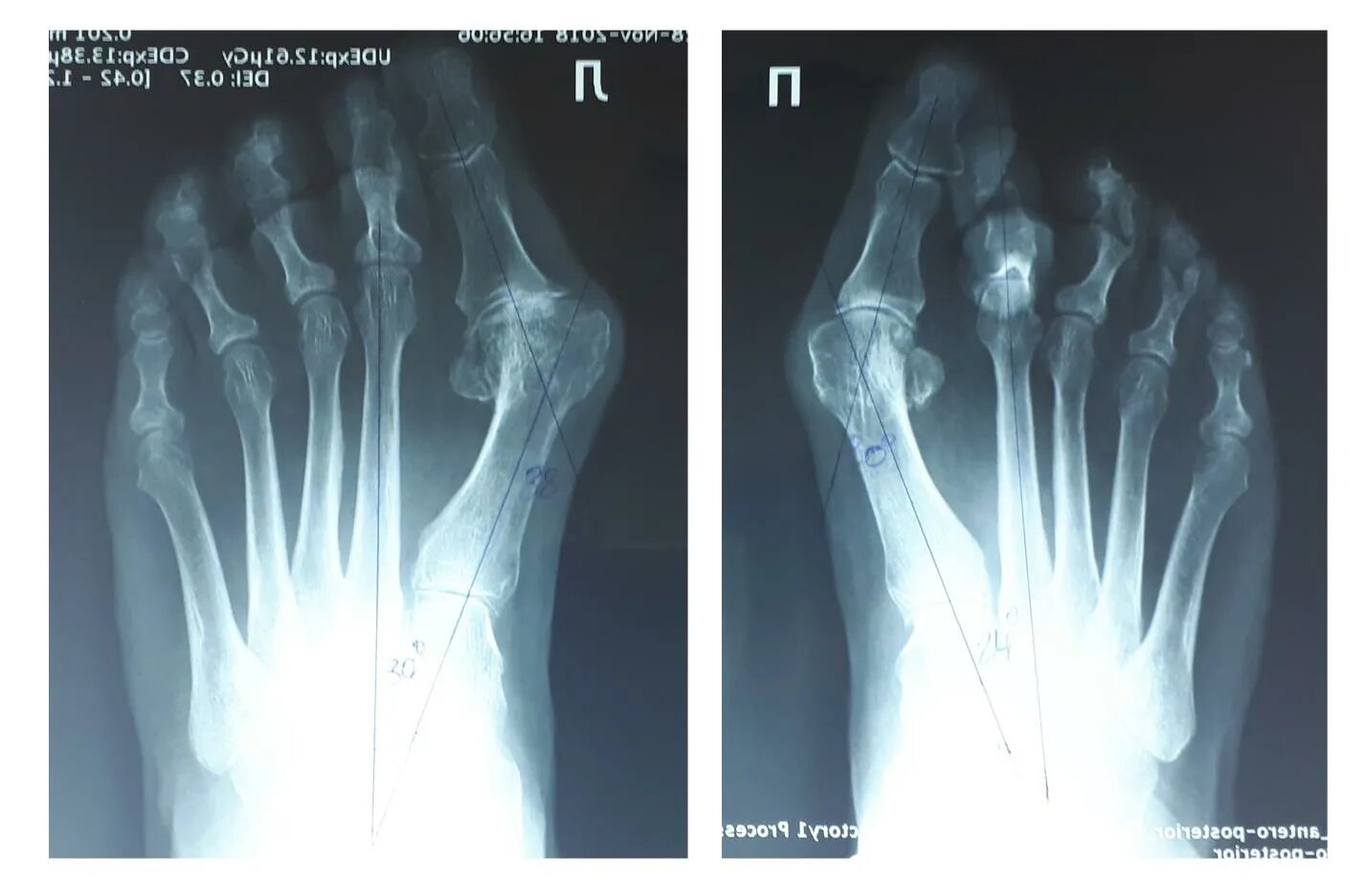 халлюкс вальгус стопы рентген. халюс вальгус рентген после операции. вальгусная деформация стопы рентген. степени халюса вальгуса рентген. вальгусная деформация большого пальца стопы рентген.