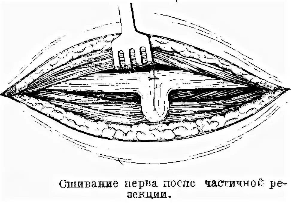 Сшивание нерва латынь