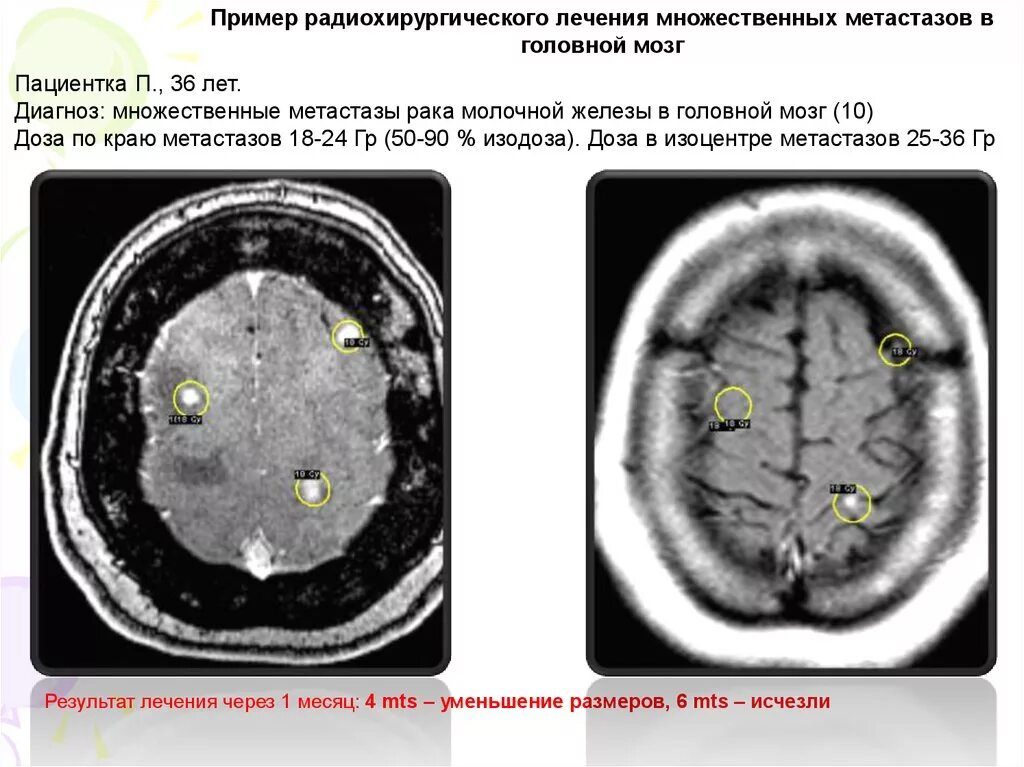 Лечение метастазов мозга