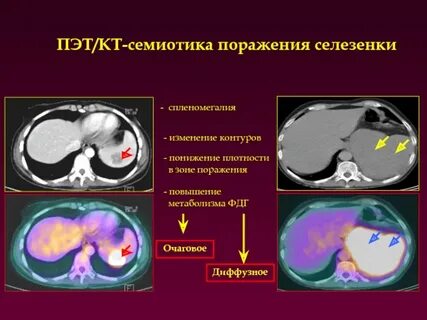 Изменение селезенки