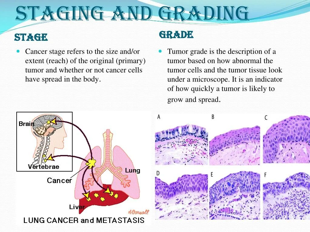 Карцинома.граде.1. Stages of cancer