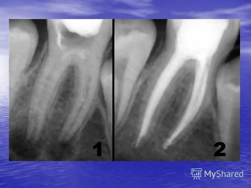 Обтурация корневого канала рентген. Пломбировка каналов зуба рентген. Пломбировка корневых каналов рентген. Периодонтит зуба рентген.