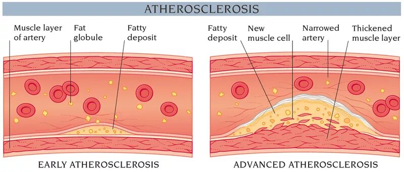 Атеросклероз оба. Атеросклероз на английском. atherosclerosis of the arteries of the lower extremities, lower extremity lymphedema.