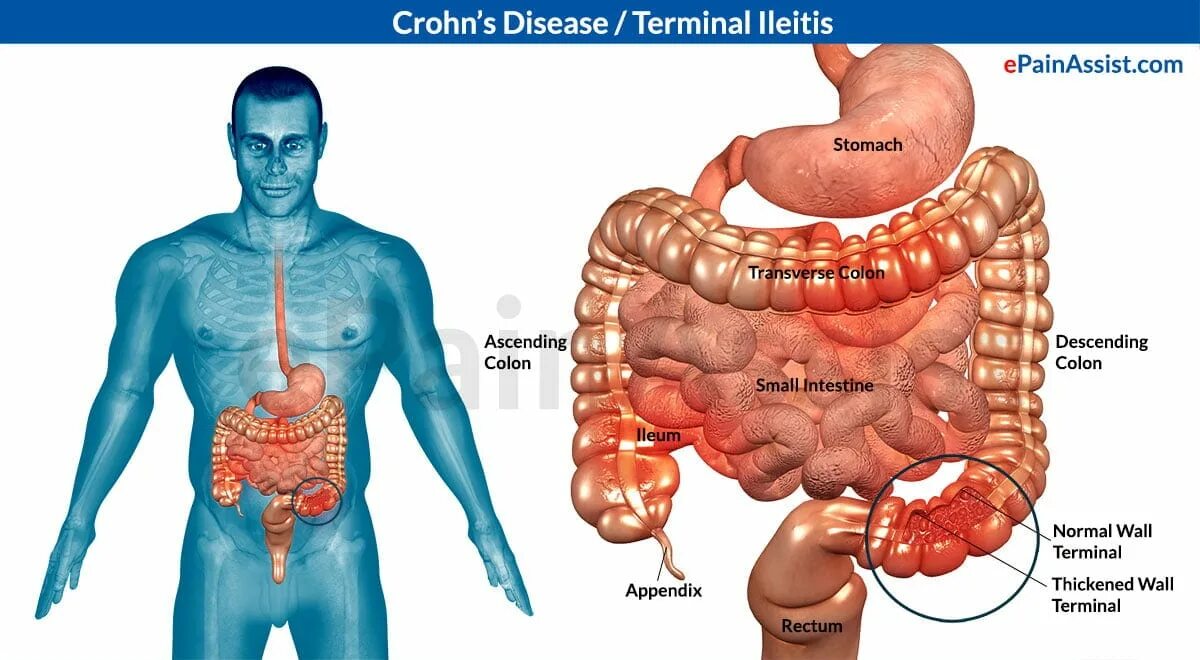 Кишечные проявления болезни крона. Болезнь крона картинки. Крон болезнь кишечника лечение