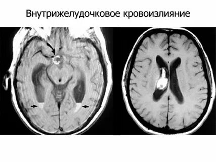 Инсульт желудочка