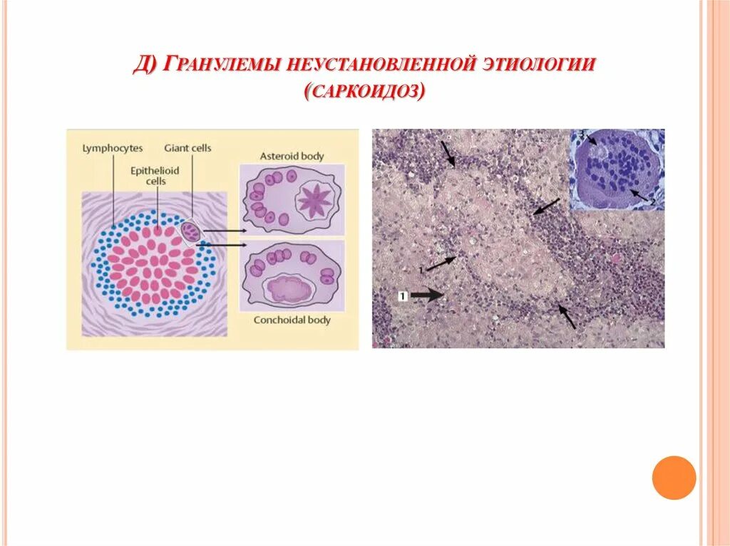 Строение саркоидной гранулемы. Саркоидная гранулема строение. Саркоидоз гранулема строение. Саркоидная гранулема гистология. Саркоидная гранулема