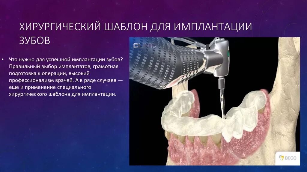 Как определить имплантацию