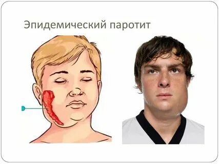 Болезнь свинка у взрослых женщин