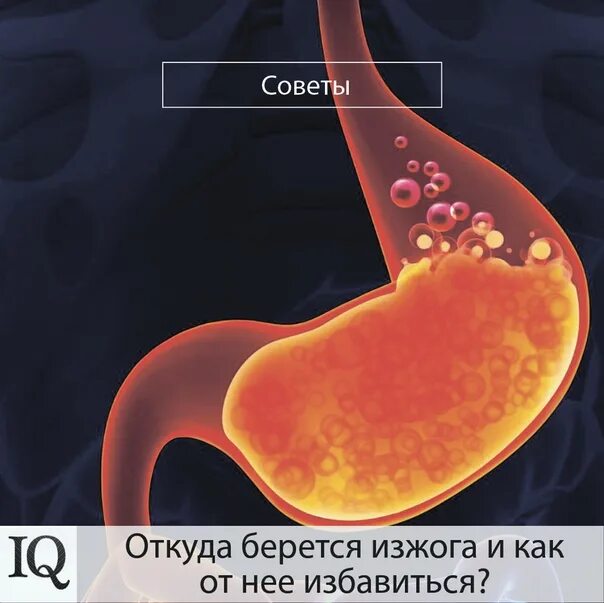 Почему изжога что делать. Причины появления изжоги.