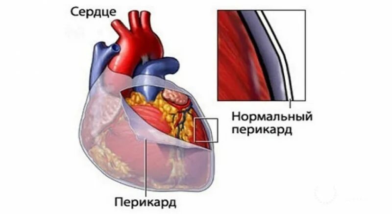 Скопление воздуха и крови в перикарде. Сердечная сумка перикард. Перикард (околосердечная сумка). Мезотелиома перикарда.