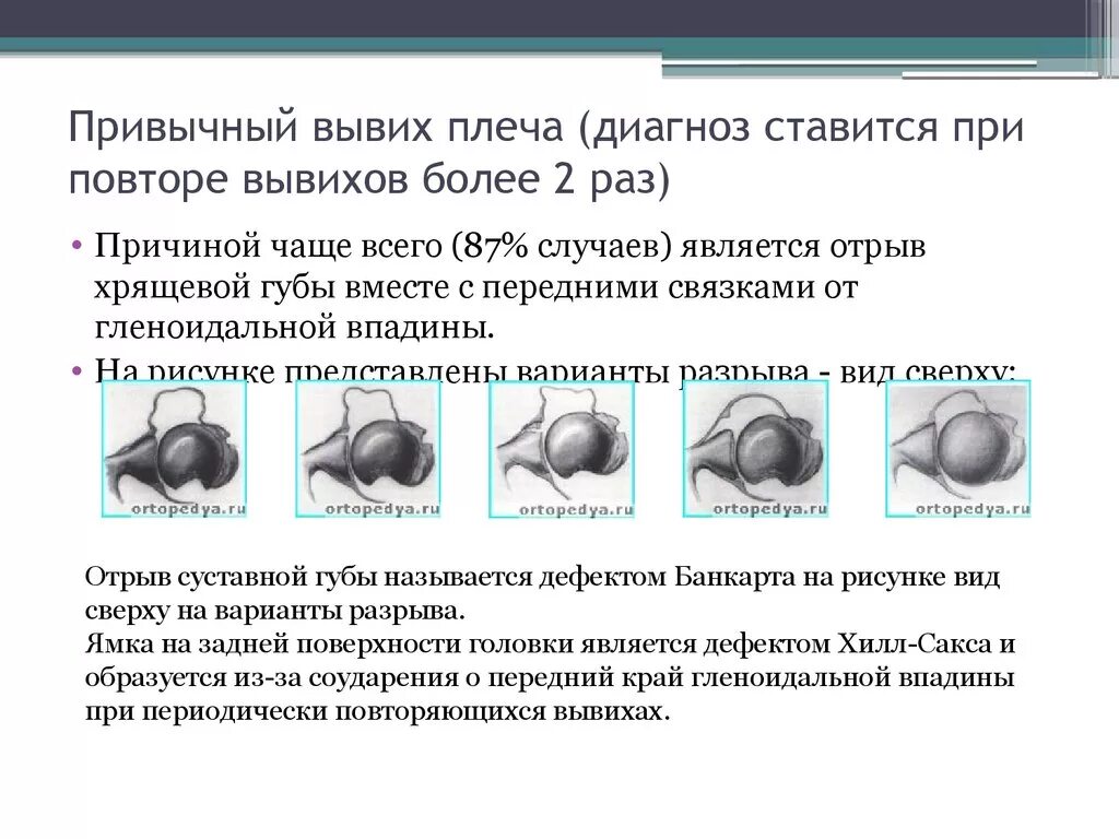 Привычный вывих плечевого сустава. Привычный вывих плечевого. диагноз привычный вывих плеча.