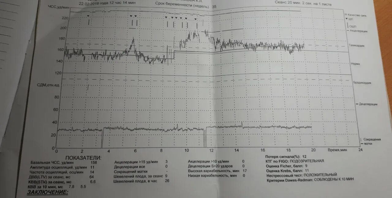 КТГ тахикардия плода 36 неделе беременности. Тахикардия на КТГ У плода. КТГ при тахикардия у плода. Учащенное сердцебиение плода на КТГ. Пульс в 3 триместре