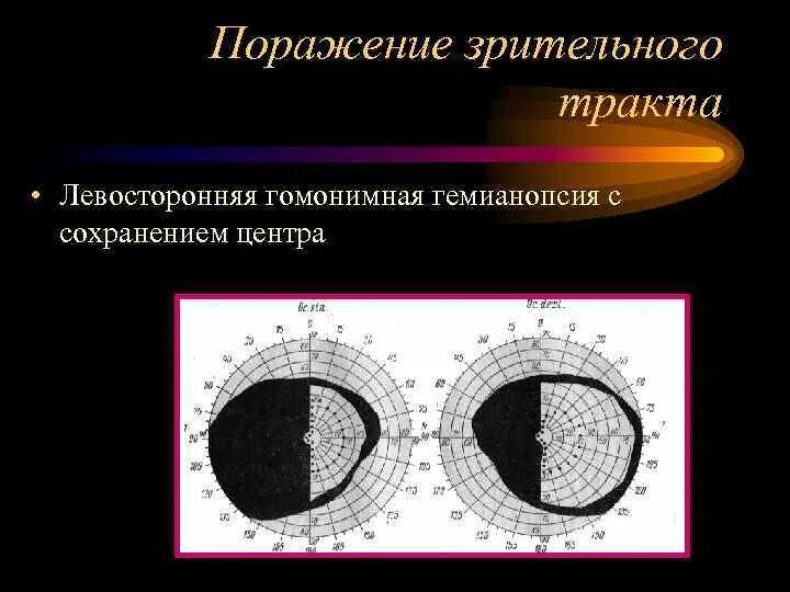 Схема полей зрения. Гомонимная гемианопсия. Правосторонняя гомонимная гемианопсия. Гомонимная гемианопсия поражение. Гомонимная гемианопсия поражение.
