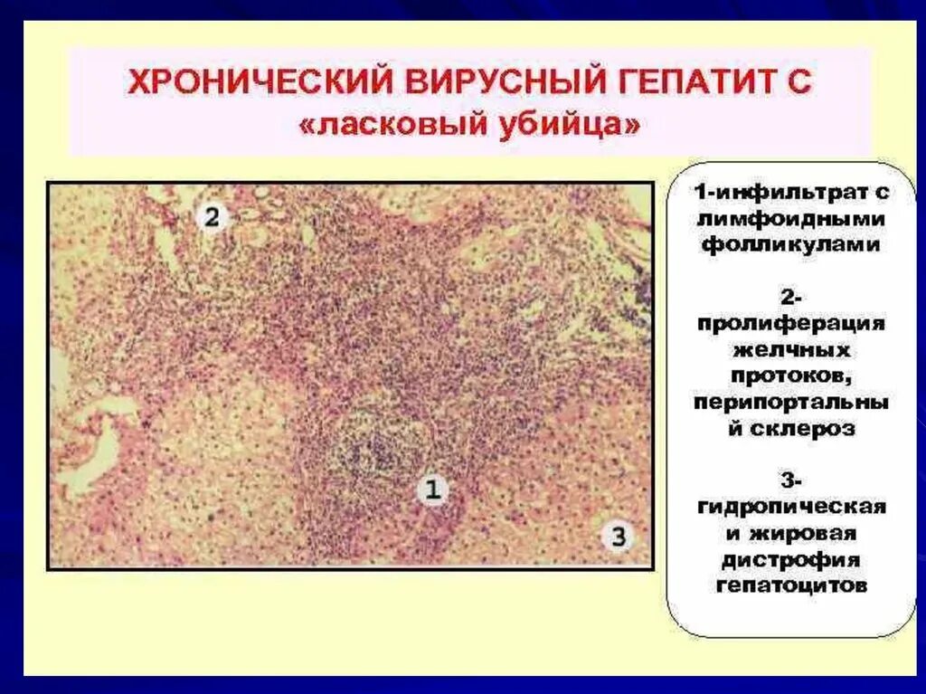 Печень микропрепарат описание. Вирусный гепатит печени микропрепарат. Гидропическая дистрофия. Хронический гепатит макропрепарат. Хронический гепатит печени макропрепарат.