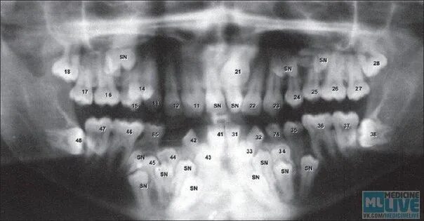 Аномалии удаления. Гипердонтия аномалия числа зубов. Гипердонтия (сверхкомплектные зубы. Сверхкомплектные зубы аномалия. Гипердонтия зубов рентген.