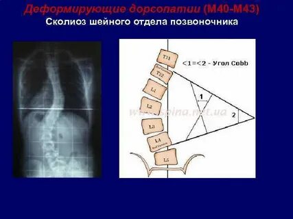 Дорсопатия шейного отдела