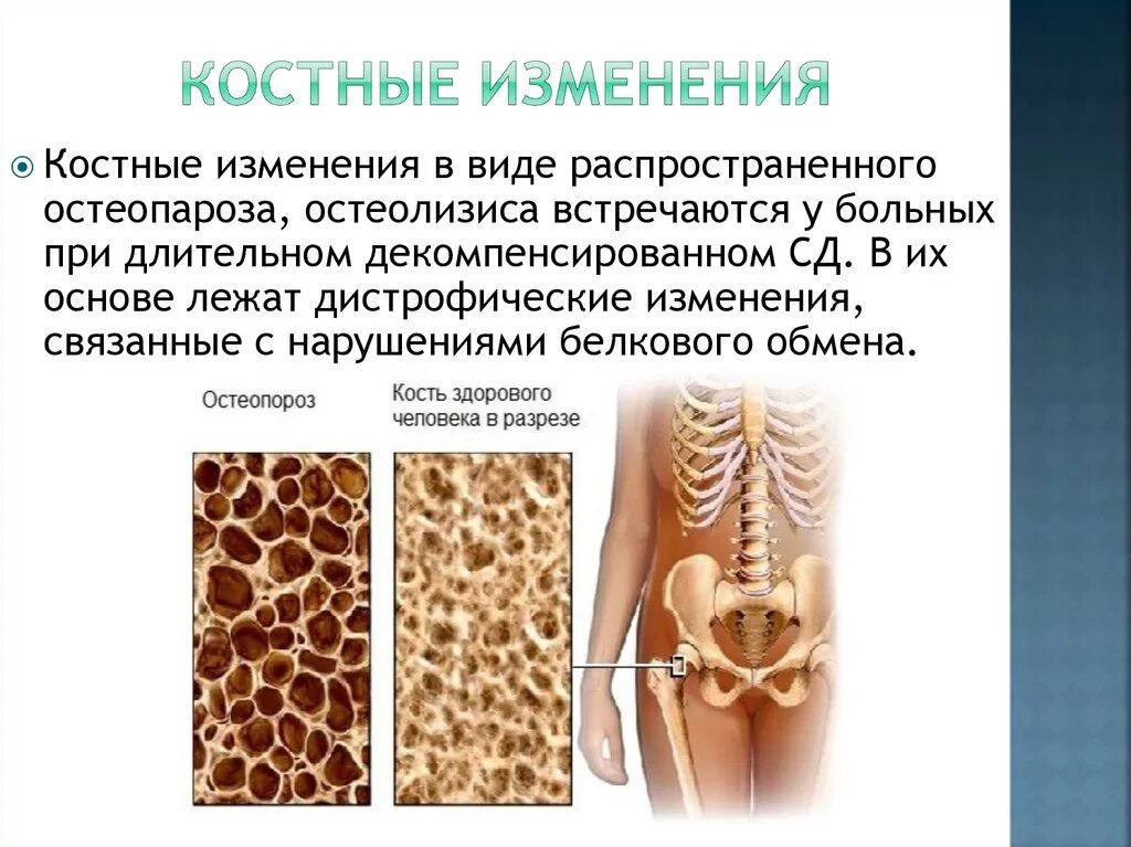 Основным признаком возрастных изменений костей. Изменение костной ткани. Возрастные изменения кости. Возрастные изменения костной ткани. Возрастные изменения костных структур.