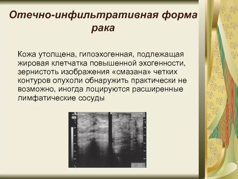 Инфильтрированная опухоль. Отечно-инфильтративная форма. Инфильтративная форма опухоли. Отечно-инфильтративная форма РМЖ. Отечно-инфильтративные изменения клетчатки.