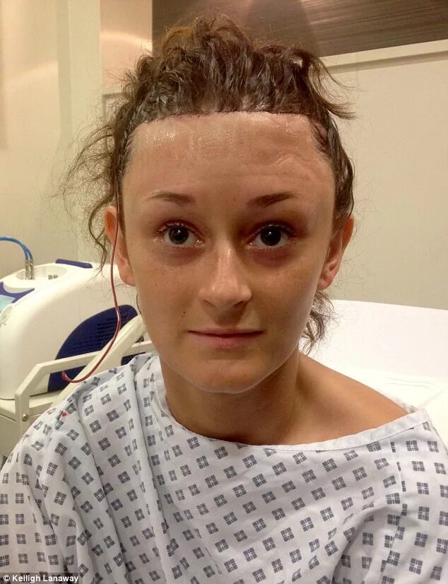 Hairline lowering surgery also known as Forehead reduction surgery rejuvenated a