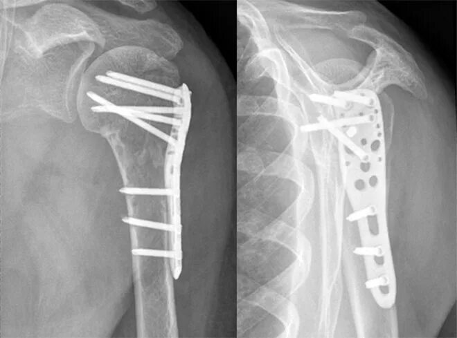 Экстрамедуллярный остеосинтез. Накостный остеосинтез рентген. Погружной чрескостный остеосинтез. Экстрамедуллярный остеосинтез рентген. Остеосинтез операция пластины
