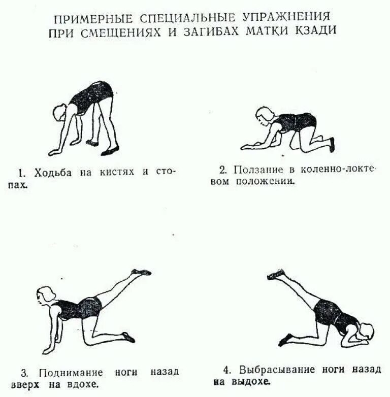 Зачатие при загибе матки